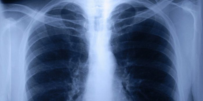 Síntomas de la Fibrosis quística y su tratamiento