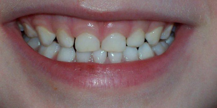 Causas de las manchas blancas en los dientes