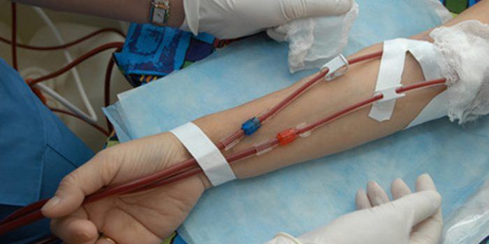 Síntomas de la anemia perniciosa