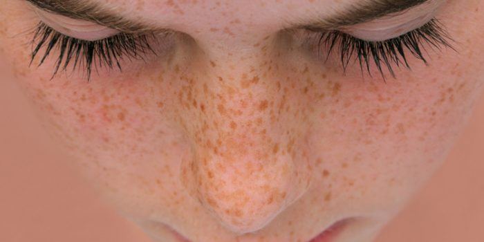 Como quitar pecas, ¿sirven los remedios naturales?