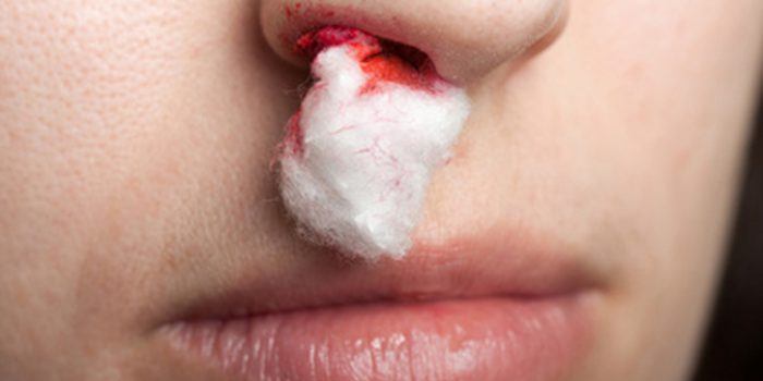 Causas de la epistaxis o sangrado de nariz, ¿qué hacer?