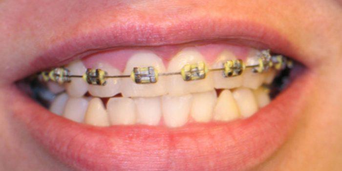 Aclaraciones sobre la ortodoncia