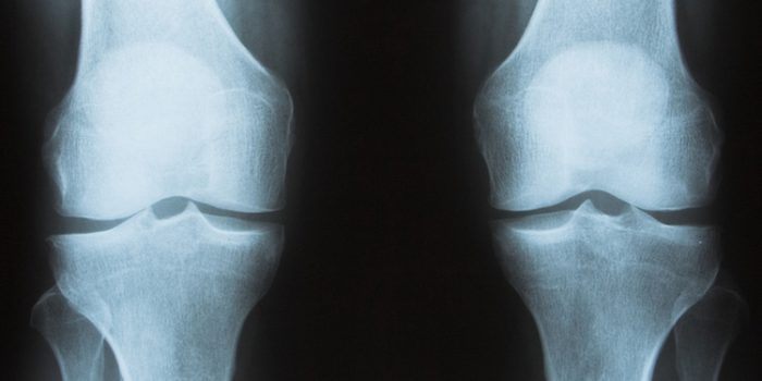 Tratamiento para la Osteoporosis con remedios naturales