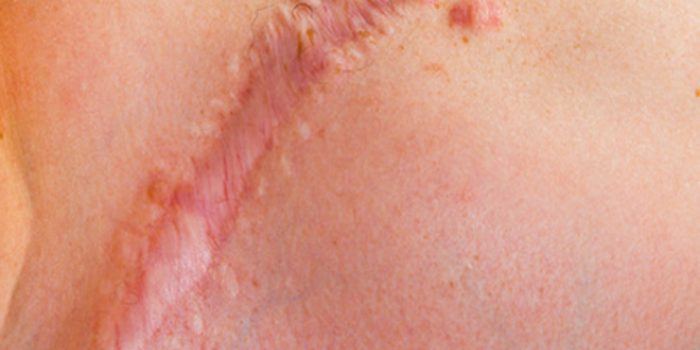 Eliminar cicatrices queloides de forma natural