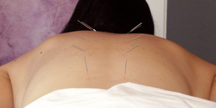 Beneficios de la acupuntura para el organismo