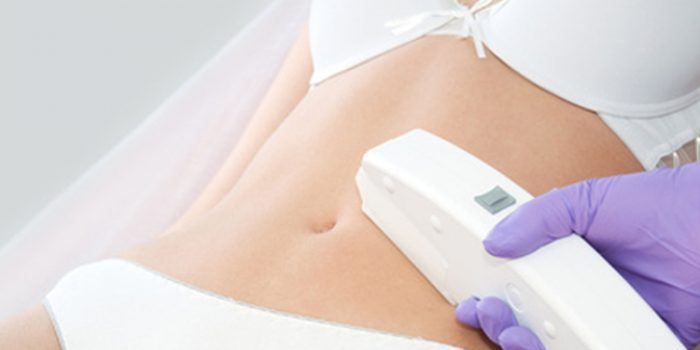 ¿Es peligrosa la fotodepilación en el embarazo?