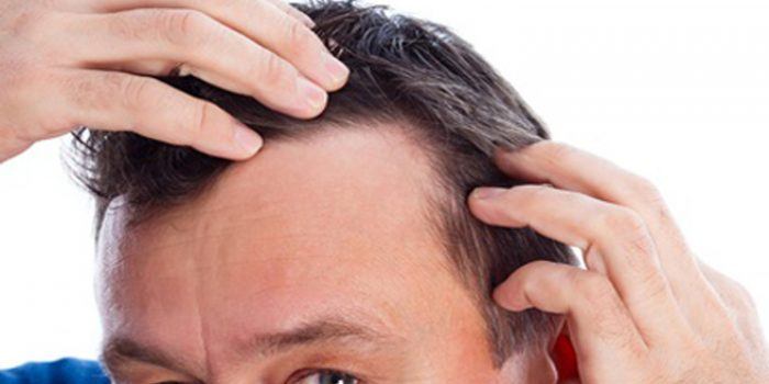 Como evitar la caída del pelo con remedios naturales