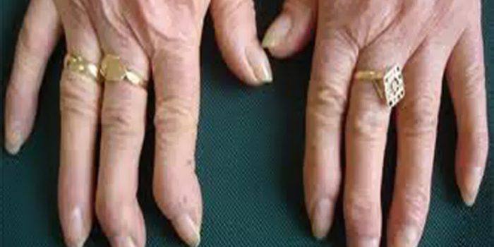 Tratamiento de la artrosis de manos