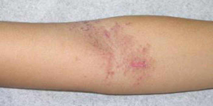 Causas de la dermatitis atópica en adultos