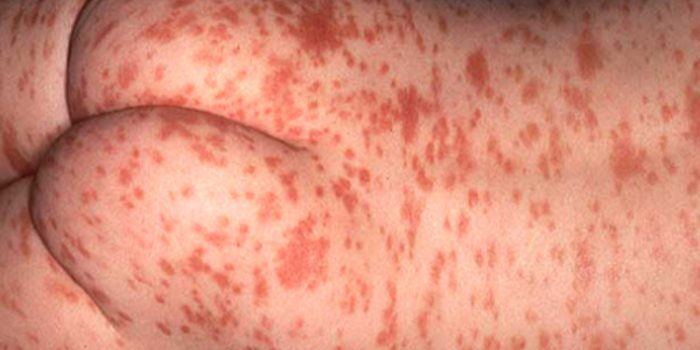 Causas de la urticaria