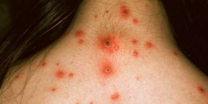 Síntomas de la varicela, terapias y remedios